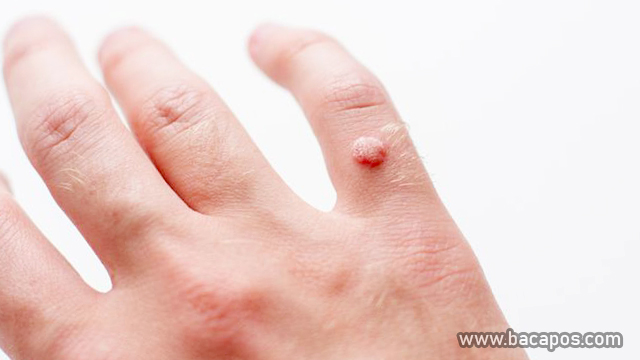 Menghilangkan Kutil Secara Alami