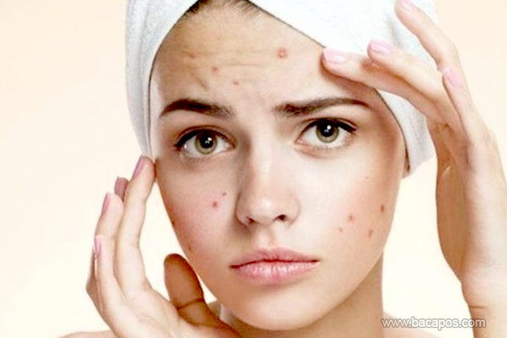 Cara mengatasi jerawat di wajah atau menghilangkan dan membersihkan jerawat secara alami